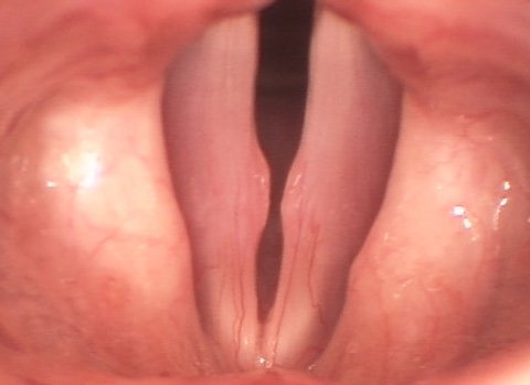 operacion nodulos cuerdas vocales