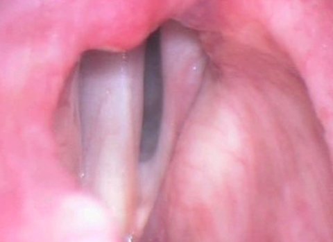 operacion insuficiencia pliegues vocales