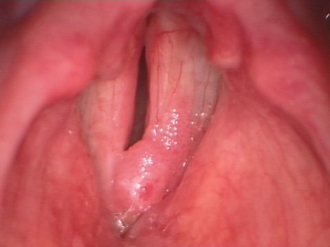 Papilomatosis laríngea