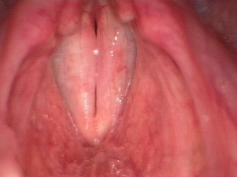 Papilomatosis laríngea después de la operación