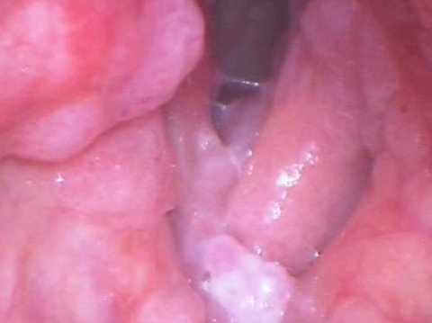 Papilomatosis pliegues vocales