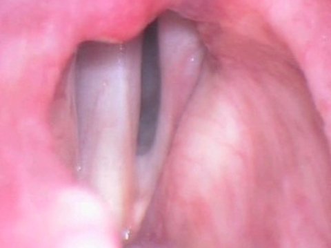 Pliegues vocales antes de la inyección de grasa