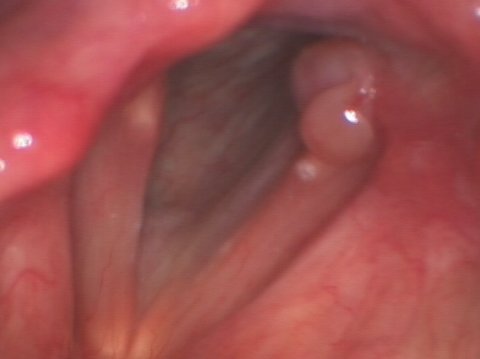 Granuloma en las cuerdas vocales