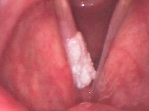 carcinoma vocal