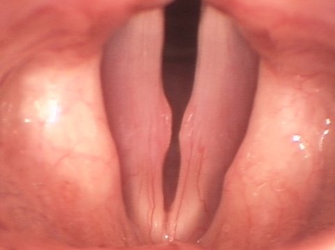 Nódulos vocales
