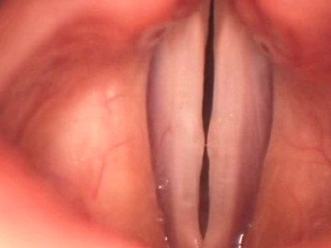 nodulos cuerdas vocales