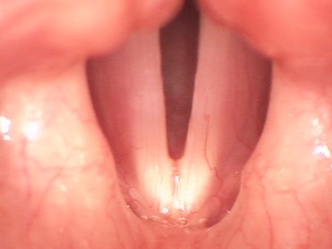 nodulos cuerdas vocales