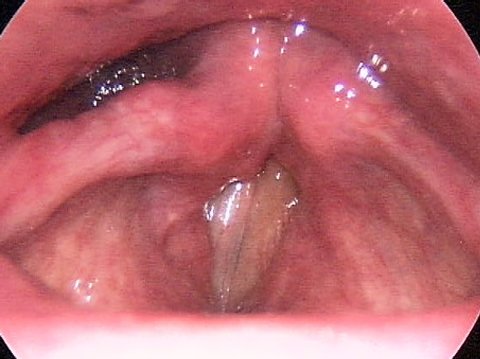 Parálisis de cuerdas vocales después de la operación