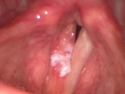 Leucoplasia de las cuerdas vocales