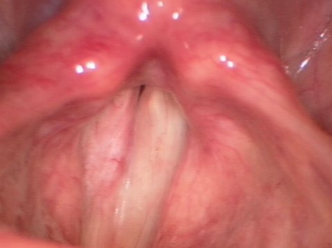 Leucoplasia de las cuerdas vocales después de la operacion