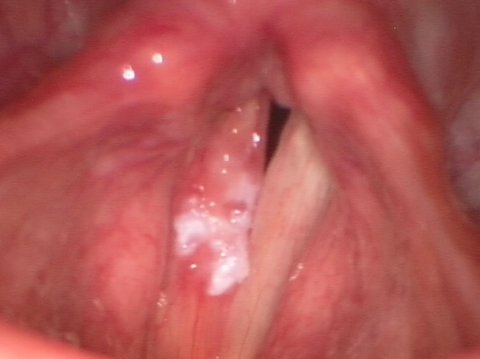 Leucoplasia de cuerdas vocales