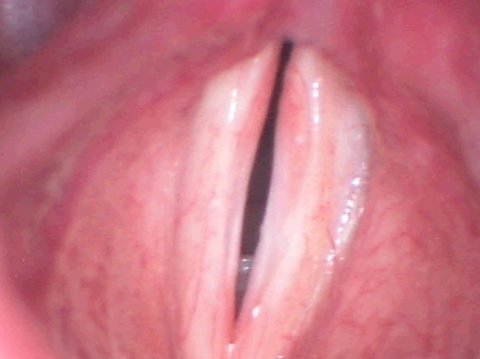 Polipo de cuerdas vocales (postoperatorio)