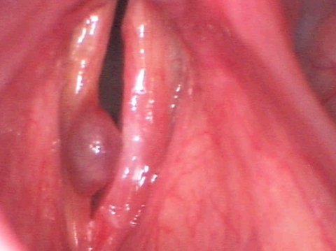 polipo cuerdas vocales